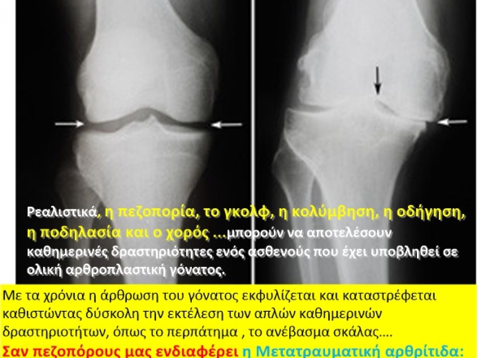 Μετατραυματική αρθρίτιδα